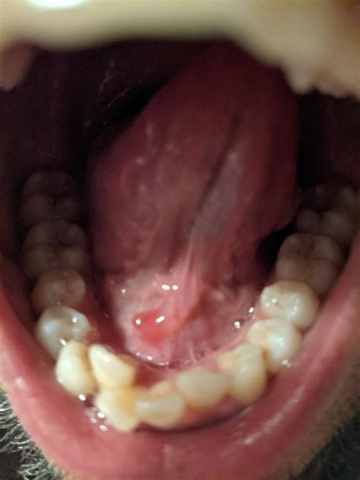 Can Putting Salt Under Your Tongue Help With ED? The Surprising Truth